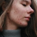 Habits That Help Young Girls Prevent Acne Breakouts.jpg